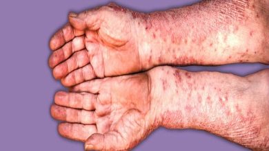 Journée mondiale du psoriasis : comprendre la maladie