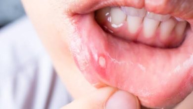Aphtes buccaux : signaux d’alerte ou simple inconfort ?