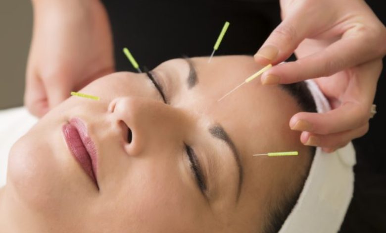 L'acupuncture esthétique va-t-elle détrôner Botox et injections ?