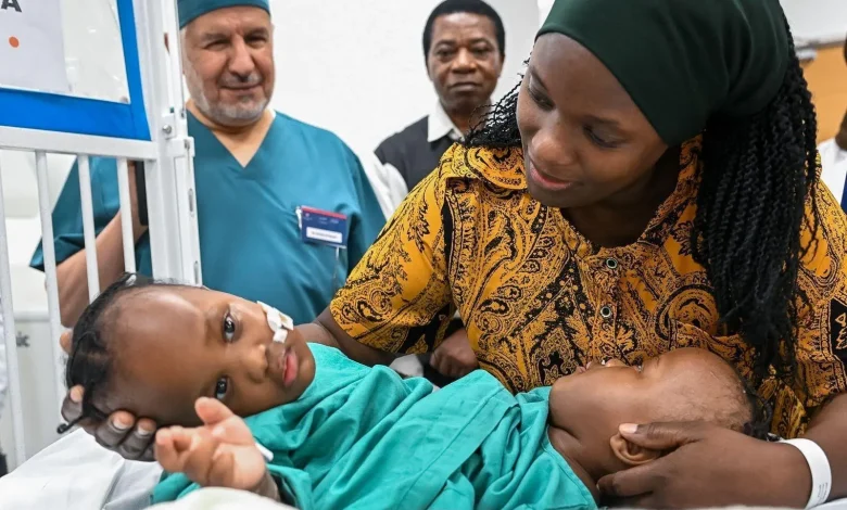 Réussite de l’opération de séparation des jumelles siamoises tanzaniennes