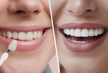 Facettes dentaires : avantages esthétiques et risques à connaître