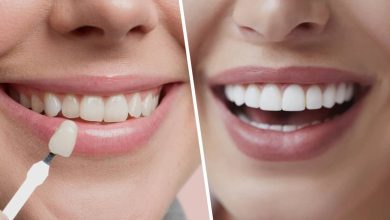 Facettes dentaires : avantages esthétiques et risques à connaître
